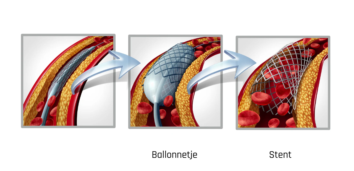 Plaatsing stent
