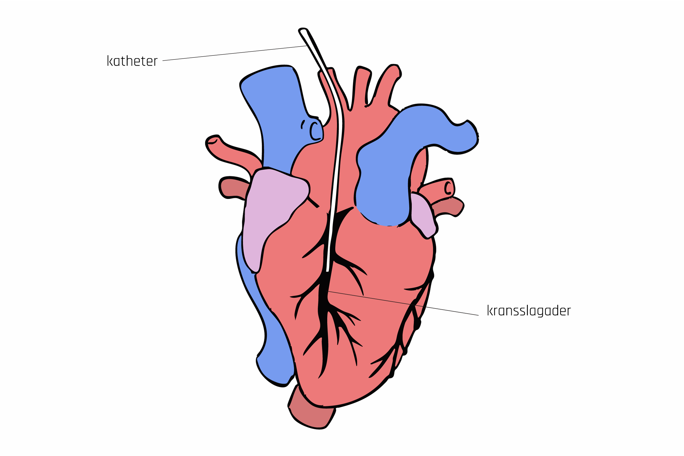 Tijdens een coronaire angiografie schuift de arts een buisje (katheter) tot in de kransslagaders in het hart.