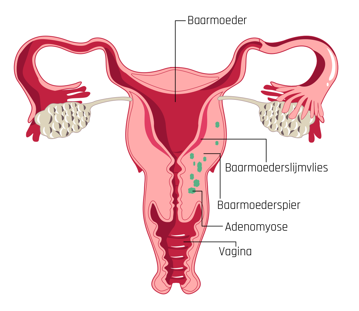 Adenomyose-haarden in de spierwand van de baarmoeder.