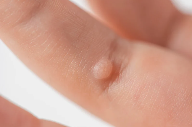 Een wratje op een vinger