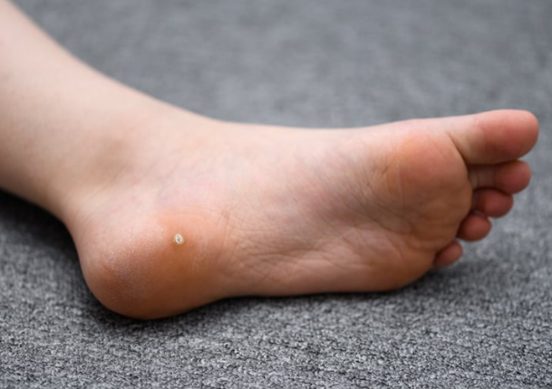 Een wrat op een voet