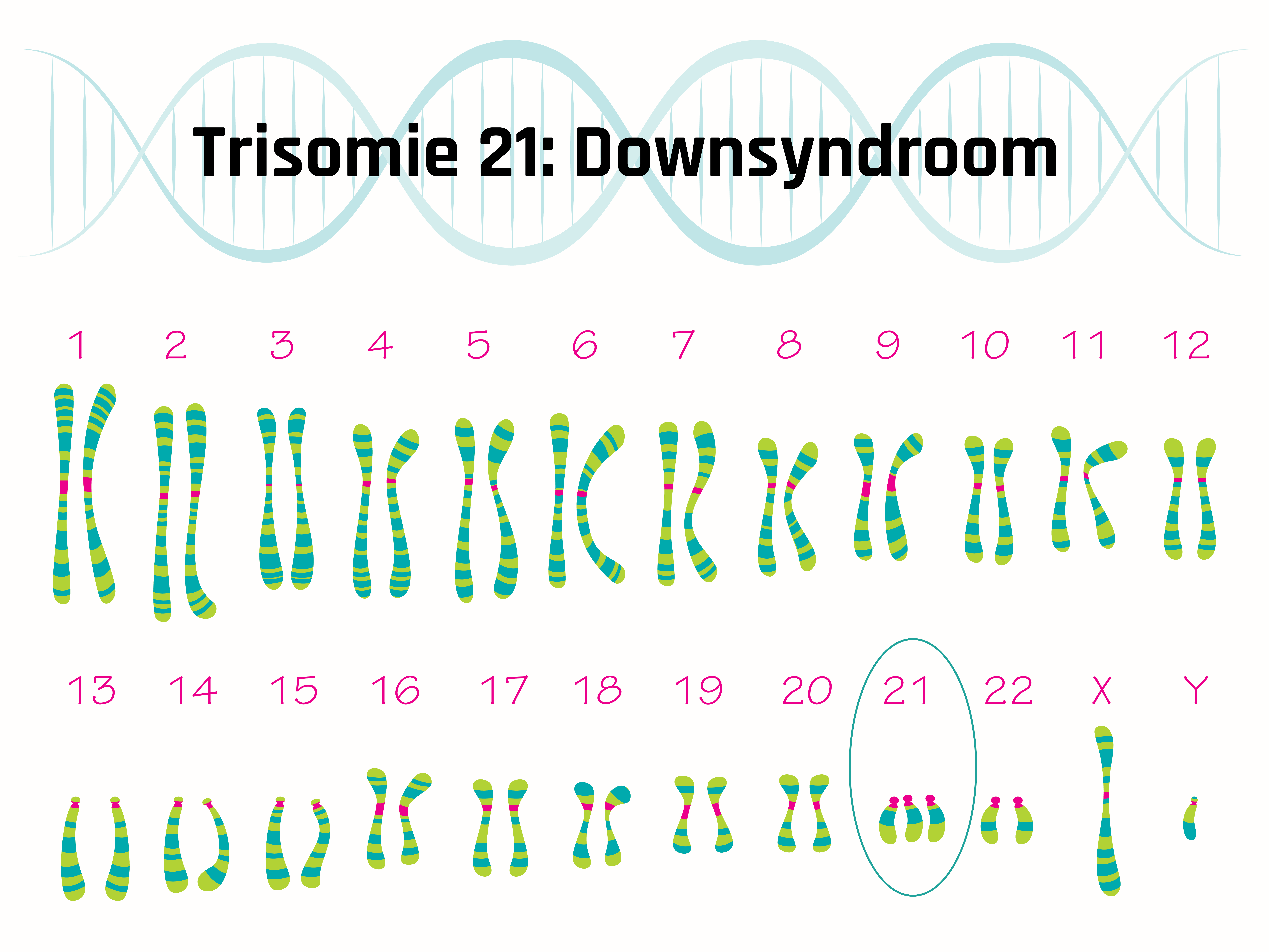 Overzicht chromosomenparen bij downsyndroom