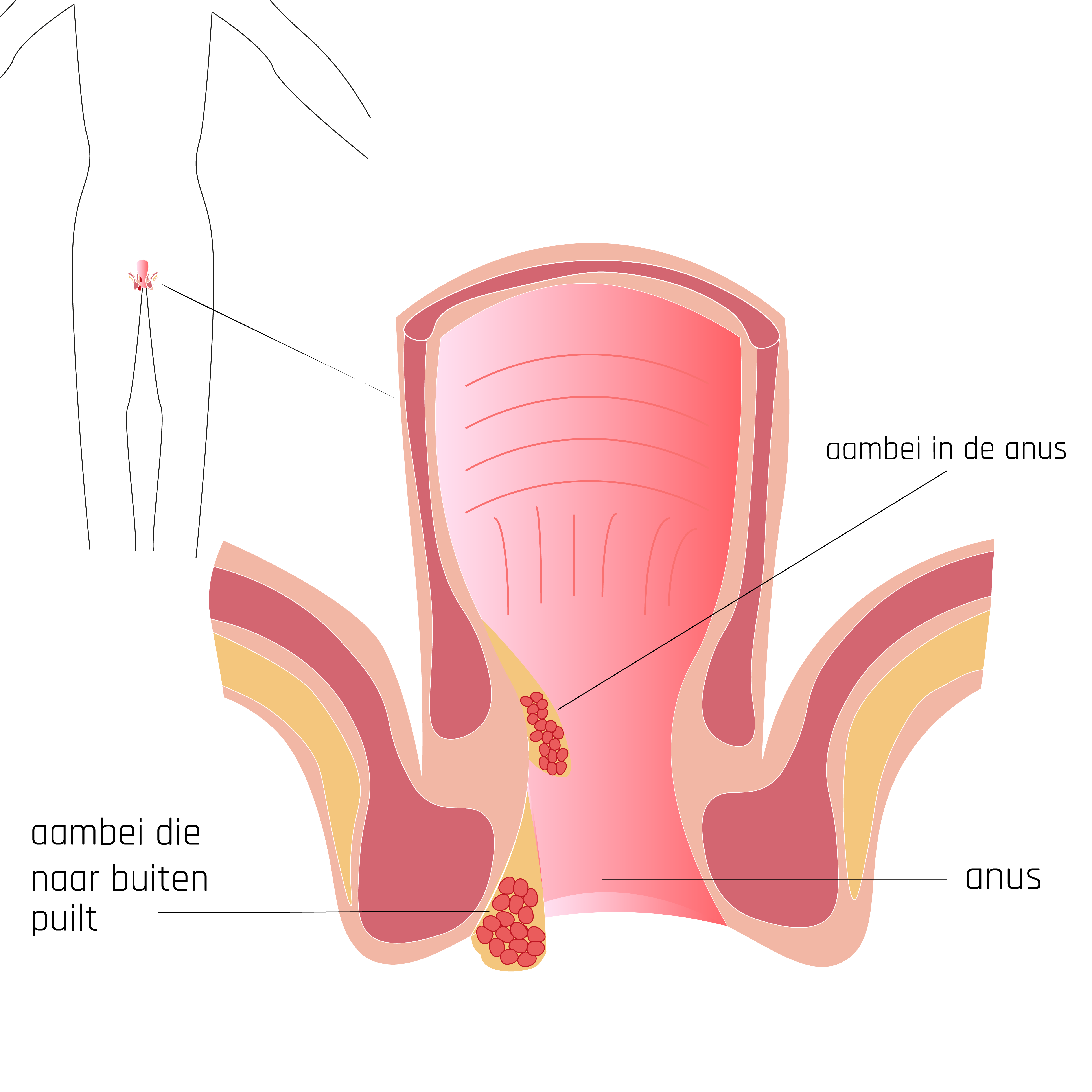 Aambeien kunnen aan de binnenkant van de anus zitten of uit de anus hangen