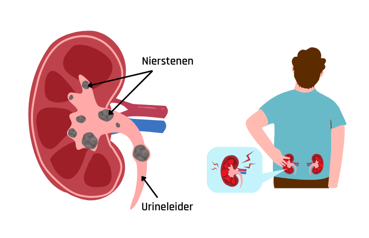 Nierstenen ontstaan in de nieren. Ze kunnen ook in de urineleider terechtkomen. Dat is het buisje dat van de nier naar de blaas loopt.