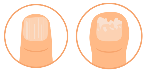 broze nagels met lijntjes en oneffenheden