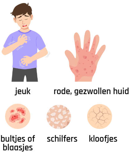 symptomen allergisch contacteczeem