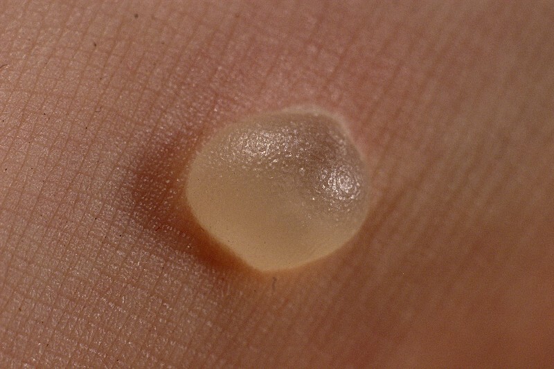 Eerste hulp bij blaren · Gezondheid en wetenschap