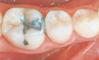 Les obturations dentaires contenant du mercure sont-elles dangereuses pour la santé ?  · Santé et science